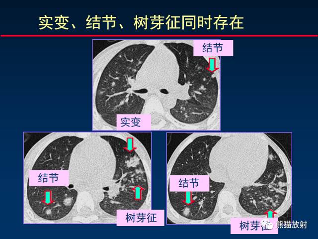 【PPT】小儿肺曲霉菌病相关CT表现分析