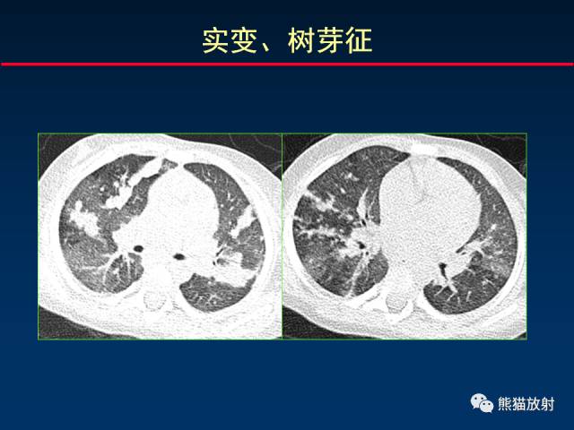 【PPT】小儿肺曲霉菌病相关CT表现分析
