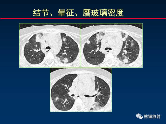 【PPT】小儿肺曲霉菌病相关CT表现分析