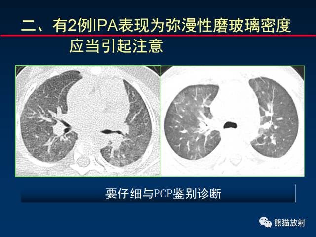 【PPT】小儿肺曲霉菌病相关CT表现分析