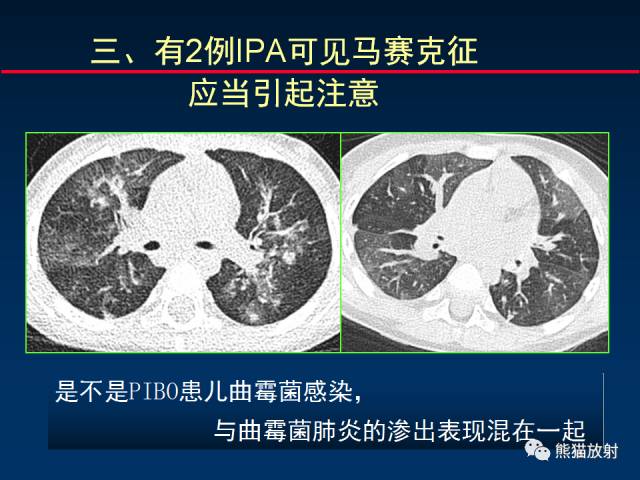 【PPT】小儿肺曲霉菌病相关CT表现分析