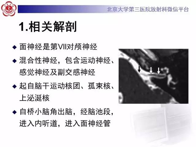 【病例】面神经鞘瘤1例CT及MR