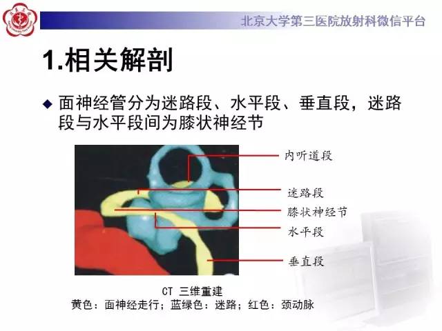 【病例】面神经鞘瘤1例CT及MR