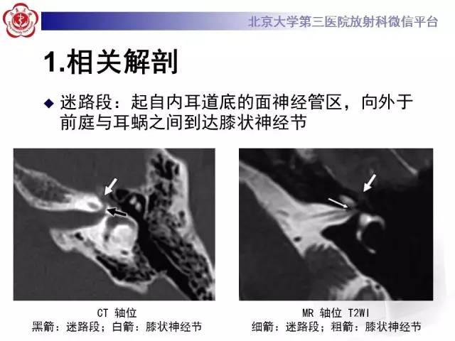 【病例】面神经鞘瘤1例CT及MR