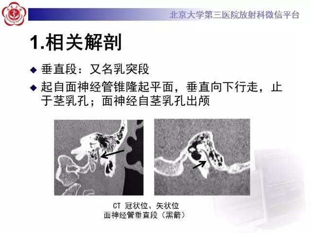 【病例】面神经鞘瘤1例CT及MR