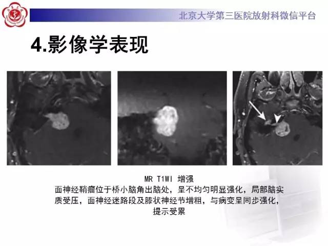 【病例】面神经鞘瘤1例CT及MR