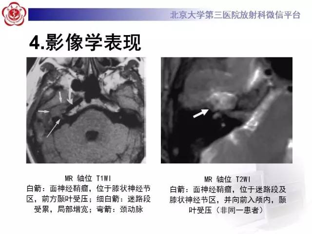 【病例】面神经鞘瘤1例CT及MR