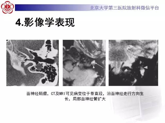 【病例】面神经鞘瘤1例CT及MR