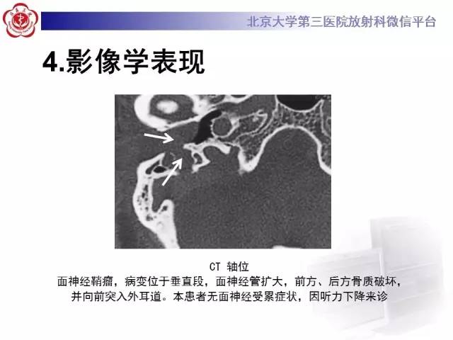 【病例】面神经鞘瘤1例CT及MR