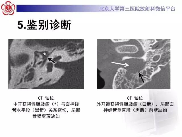 【病例】面神经鞘瘤1例CT及MR