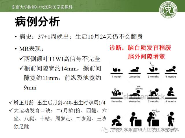 【病例】脑白质发育稍缓，脑外间隙增宽1例MR