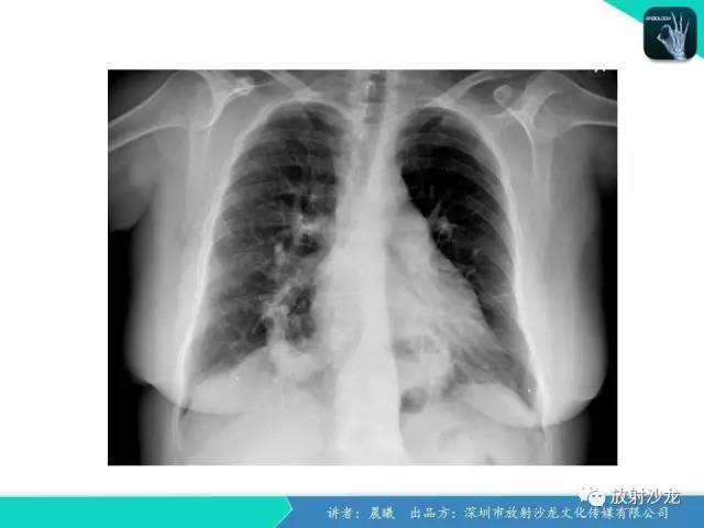 【病例】弯刀综合征1例CT影像表现