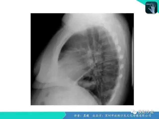 【病例】弯刀综合征1例CT影像表现