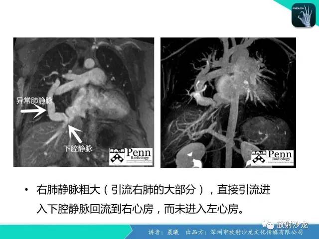 【病例】弯刀综合征1例CT影像表现