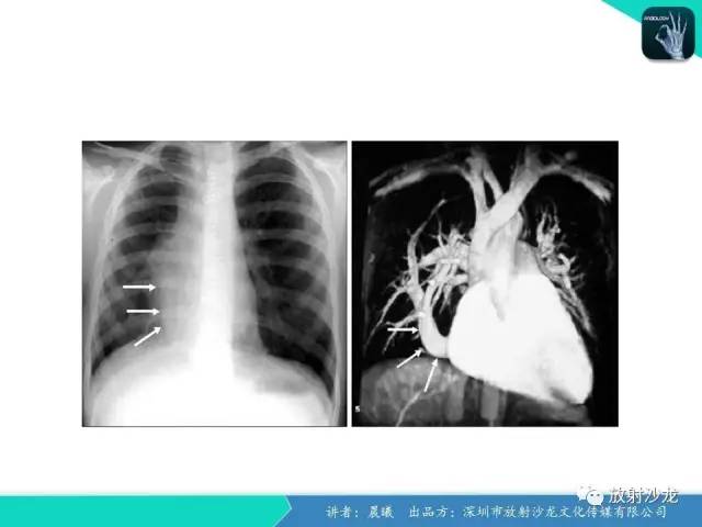 【病例】弯刀综合征1例CT影像表现