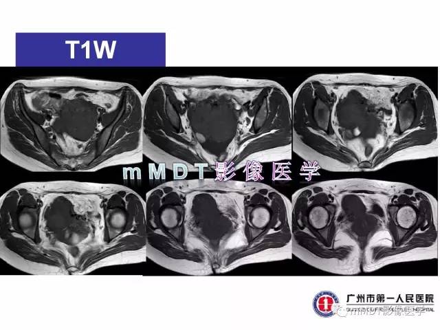 【病例】卵巢透明细胞癌1例MR影像表现