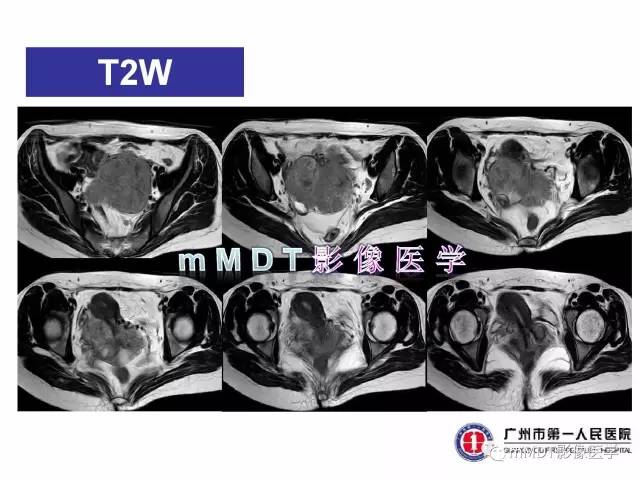 【病例】卵巢透明细胞癌1例MR影像表现