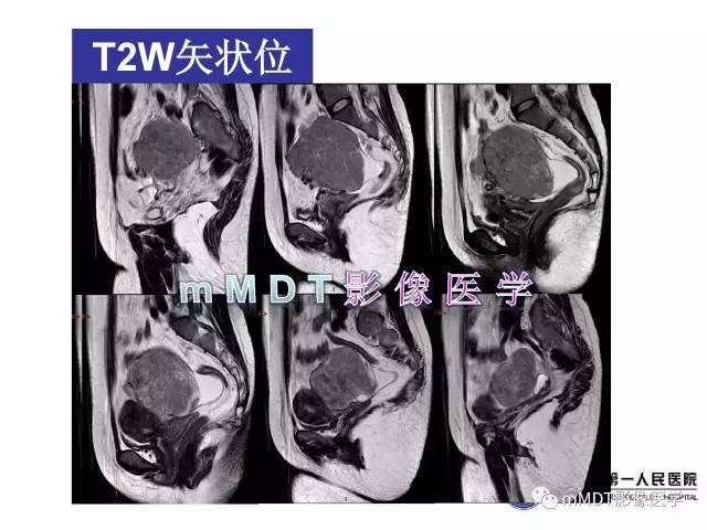 【病例】卵巢透明细胞癌1例MR影像表现