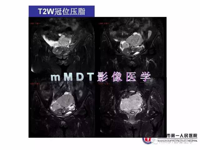 【病例】卵巢透明细胞癌1例MR影像表现