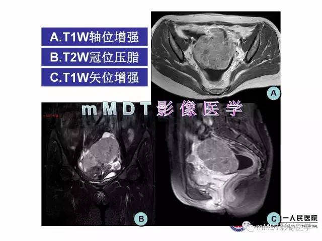 【病例】卵巢透明细胞癌1例MR影像表现