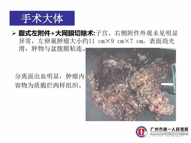 【病例】卵巢透明细胞癌1例MR影像表现