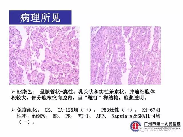 【病例】卵巢透明细胞癌1例MR影像表现