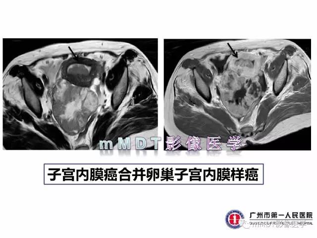 【病例】卵巢透明细胞癌1例MR影像表现