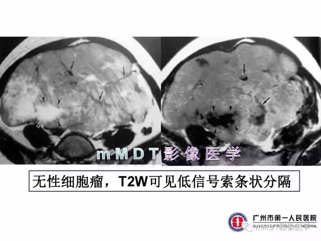 【病例】卵巢透明细胞癌1例MR影像表现