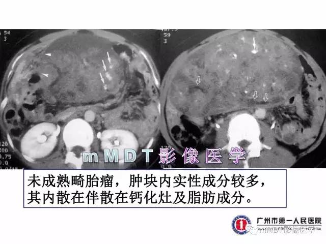 【病例】卵巢透明细胞癌1例MR影像表现