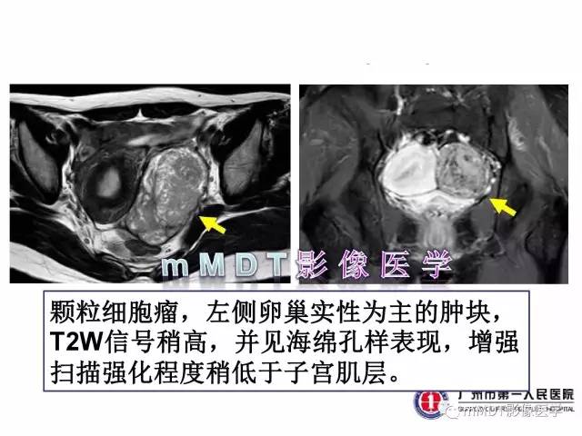 【病例】卵巢透明细胞癌1例MR影像表现