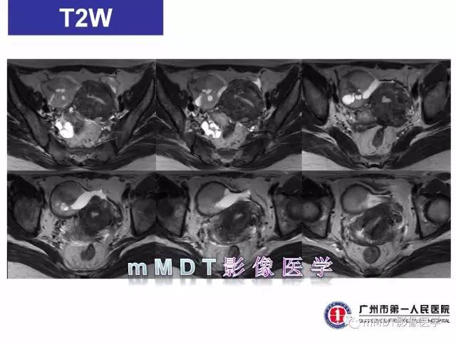 【病例】卵巢子宫内膜间质肉瘤1例MR