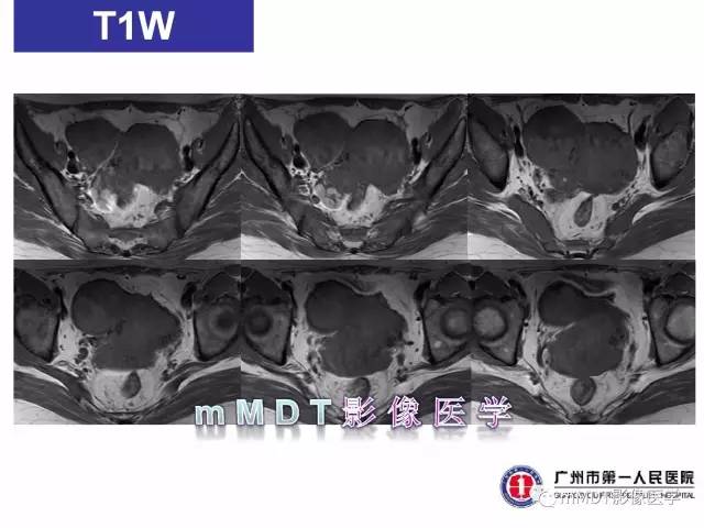 【病例】卵巢子宫内膜间质肉瘤1例MR