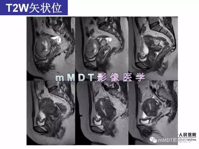 【病例】卵巢子宫内膜间质肉瘤1例MR