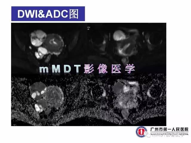 【病例】卵巢子宫内膜间质肉瘤1例MR
