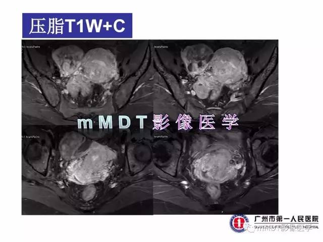 【病例】卵巢子宫内膜间质肉瘤1例MR