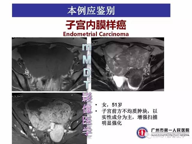 【病例】卵巢子宫内膜间质肉瘤1例MR
