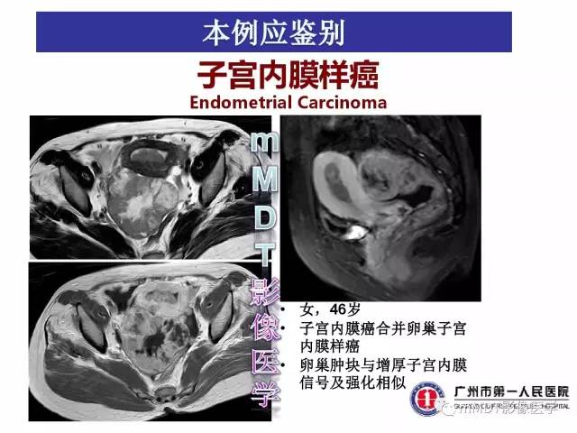 【病例】卵巢子宫内膜间质肉瘤1例MR