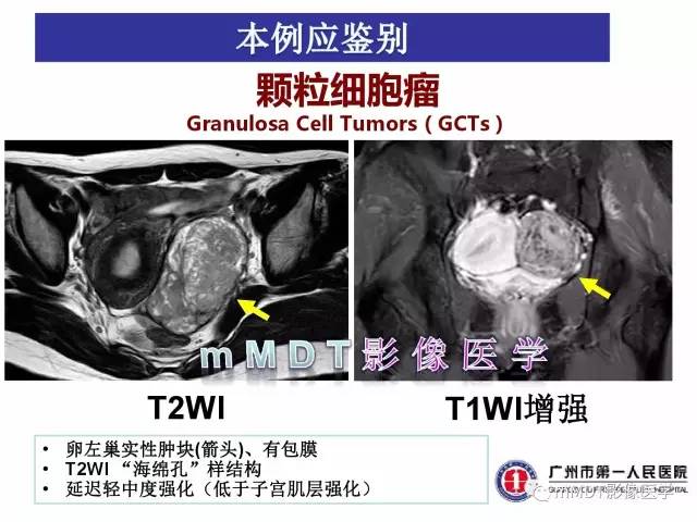 【病例】卵巢子宫内膜间质肉瘤1例MR