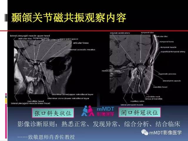 【PPT】颞下颌关节内紊乱的MR诊断