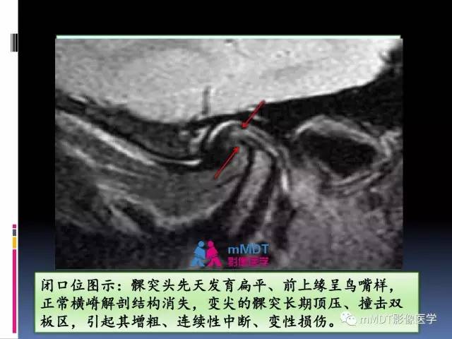 【PPT】颞下颌关节内紊乱的MR诊断