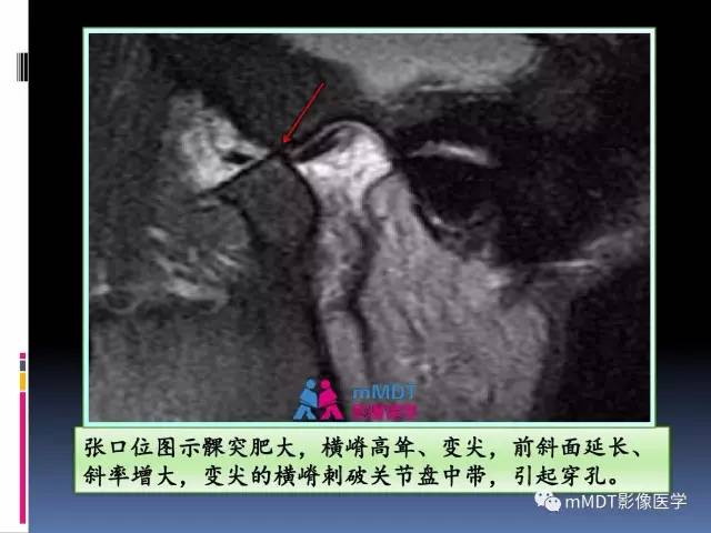 【PPT】颞下颌关节内紊乱的MR诊断