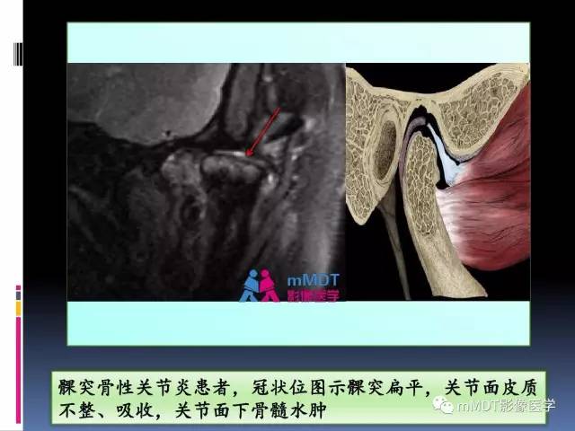 【PPT】颞下颌关节内紊乱的MR诊断