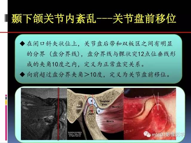 【PPT】颞下颌关节内紊乱的MR诊断