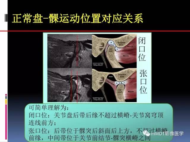 【PPT】颞下颌关节内紊乱的MR诊断