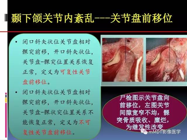 【PPT】颞下颌关节内紊乱的MR诊断