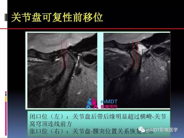 【PPT】颞下颌关节内紊乱的MR诊断