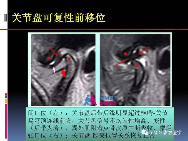 【PPT】颞下颌关节内紊乱的MR诊断