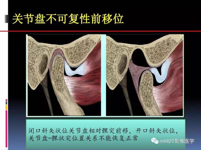 【PPT】颞下颌关节内紊乱的MR诊断