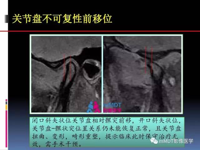 【PPT】颞下颌关节内紊乱的MR诊断