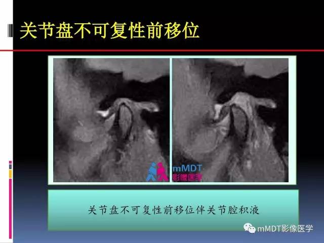 【PPT】颞下颌关节内紊乱的MR诊断